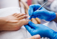 Does Nail Matrix Treatment Prevent Ingrown Toenail Recurrence?
